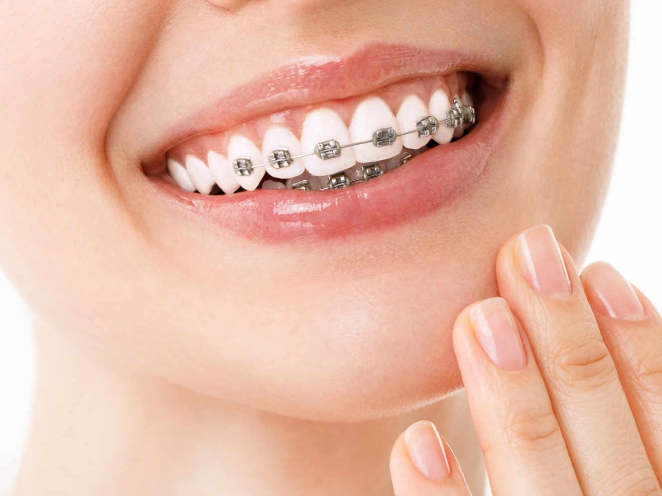 Установка брекетов