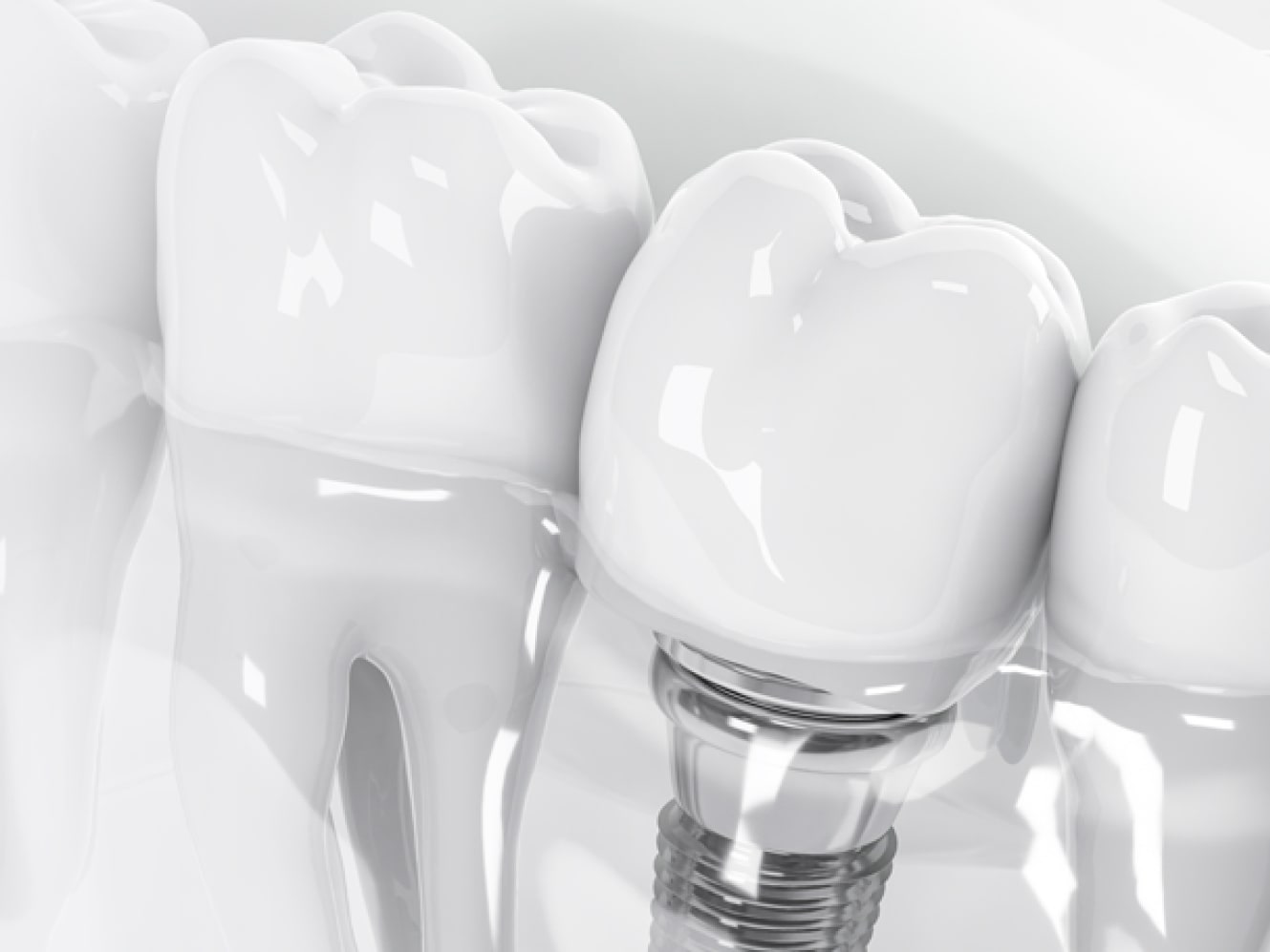 Имплантация