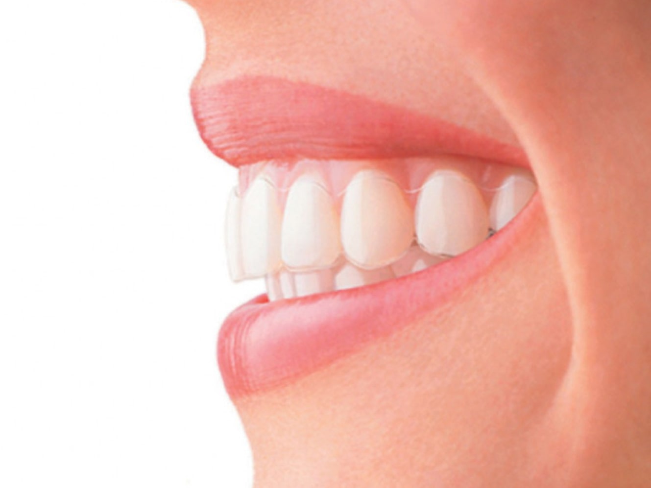 Исправление прикуса