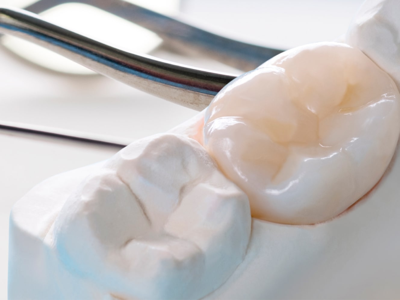  Периодонтит